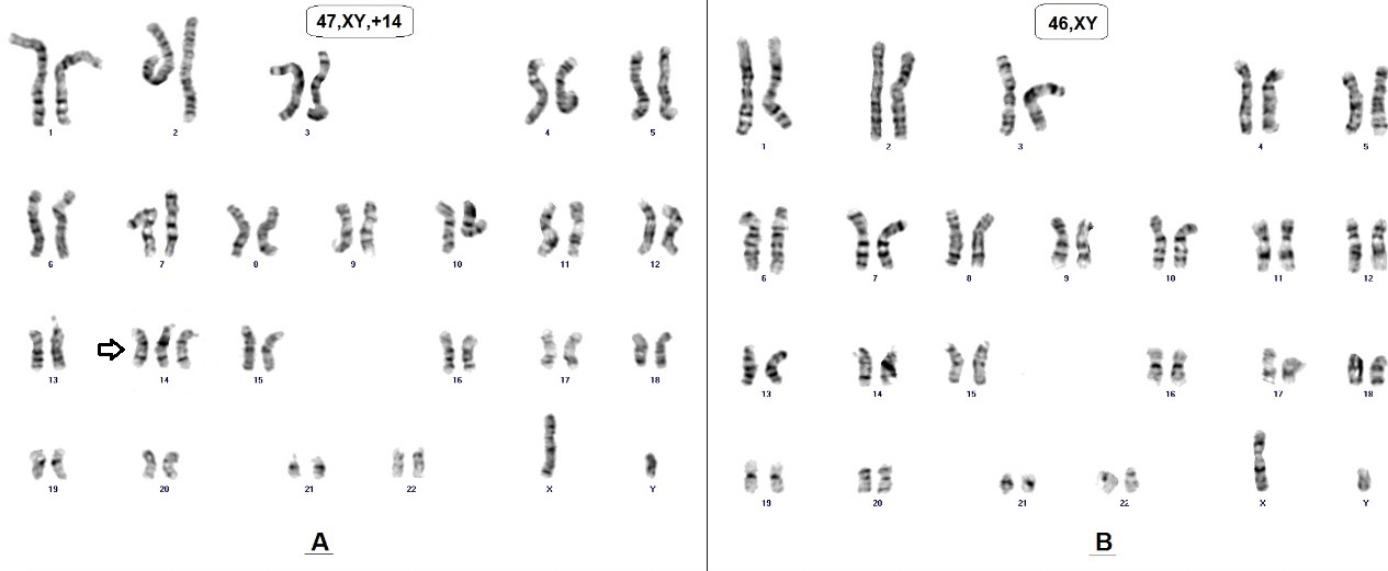 Imagem do cariótipo da trissomia do cromossomo 14 em mosaico (47,XY,+14[8]/46,XY[192]). A. linhagem celular alterada com cariótipo 47,XY,+14. B. linhagem celular normal com cariótipo 46,XY