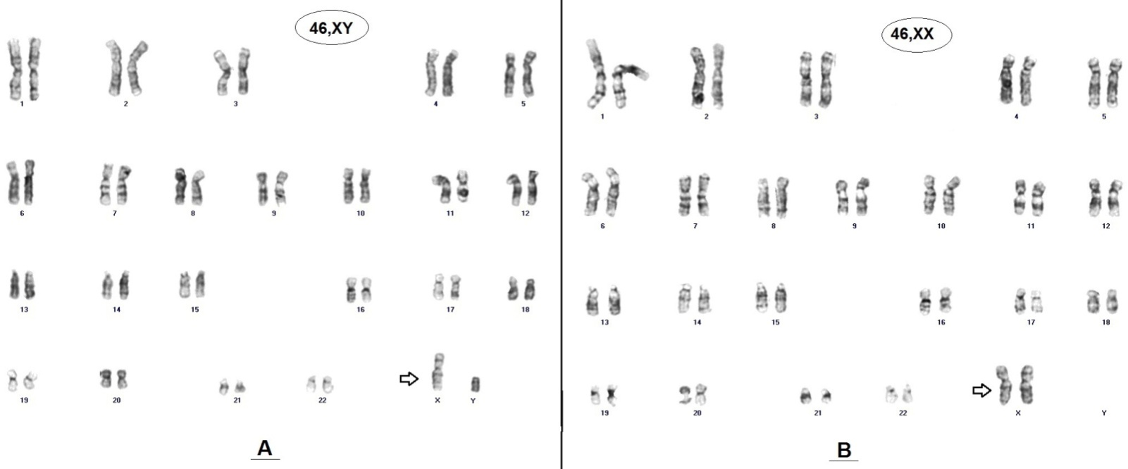 Imagem do cariótipo do mosaicismo 46,XY[34]/46,XX[31]. A. linhagem celular cariótipo 47,XY. B. linhagem com cariótipo 46,XX